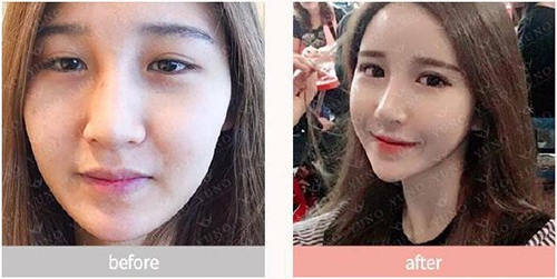 韩国朱诺整形外科鼻子整形前后案例