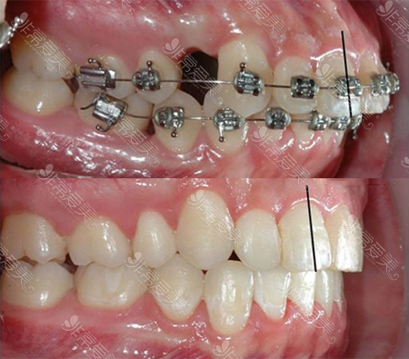 龅牙矫正前后对比差异