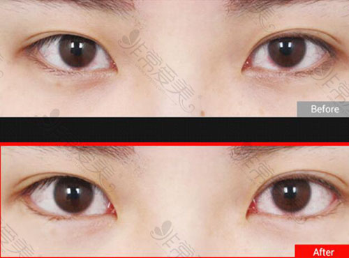 韩国K整形眼角手术照片