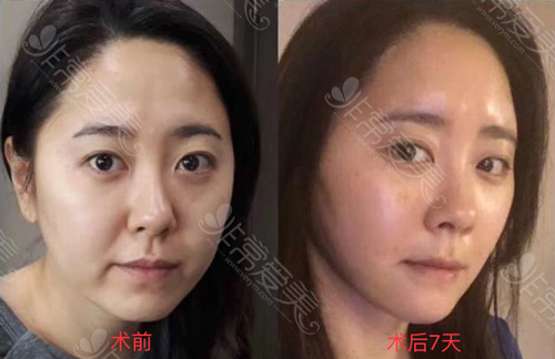 韩国拉皮手术对比照片，记录7天、12天图片展示
