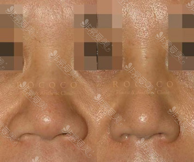 韩国ROCOCO整形外科鼻头缩小案例图