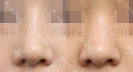 韩国高诺鼻CONOPI整形外科医院鼻翼鼻头缩小案例图