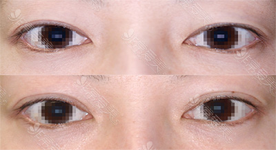 日本酒井形成外科医院双眼皮案例图