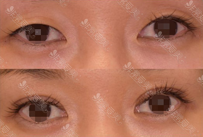 日本割双眼皮医院排名，告诉你日本哪家双眼皮做得好