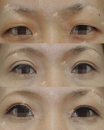 日本银座S美容形成外科医院双眼皮案例图