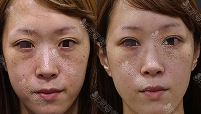 日本Sapho整形医院双眼皮案例图