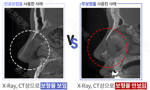 X-ARY影像中假体隆鼻和自体组织隆鼻对比