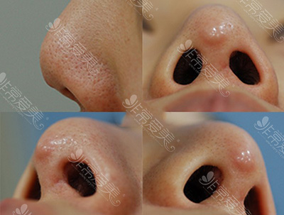 硅胶假体隆鼻造成鼻尖红肿问题