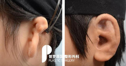 取肋骨做耳朵的后遗症有哪些，为什么不建议初次用肋骨？