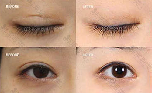 韩国soonplus双眼皮疤痕修复案例