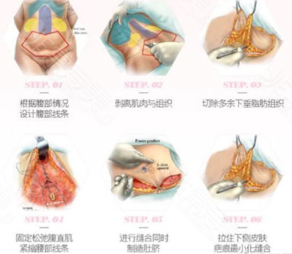 腹壁成型手术创伤非常大是真的吗 听说还能改善腹直肌分离