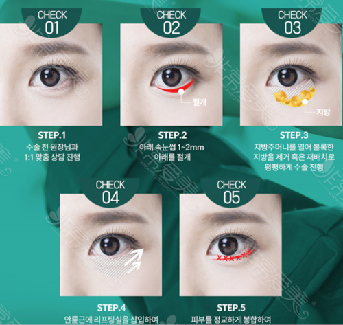 韩国neo整形眼部手术过程图解