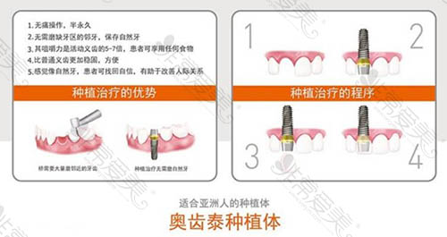 韩国种植牙品牌怎么样？盘点常见奥齿泰、neo、登腾种植体