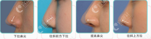 日本银座S美容形成外科酒井直彦院长隆鼻方法