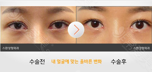 眼角修复手术对比图