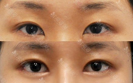韩国歌柔飞整形医院双眼皮修复案例对比