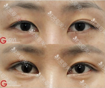 韩国歌柔飞整形医院双眼皮修复案例图