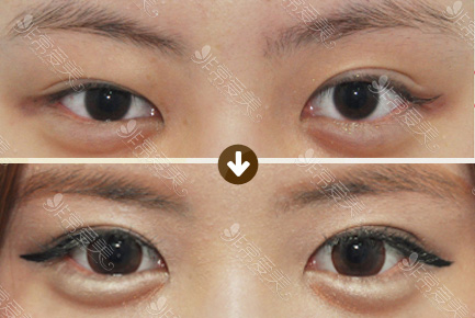 韩国歌柔飞整形医院双眼皮修复效果对比