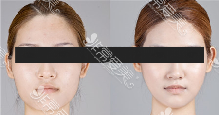 韩国ID医院下颌角术前术后对比图