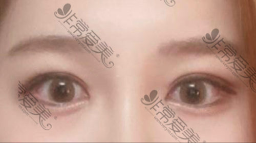 韩国Toptier整形外科眼修复手术