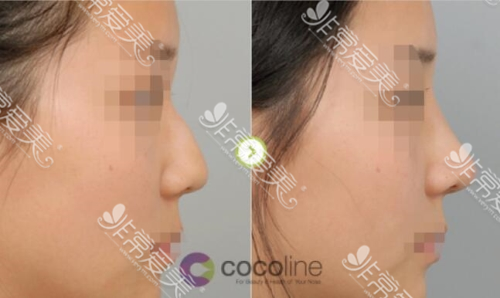 韩国cocoline隆鼻案例图