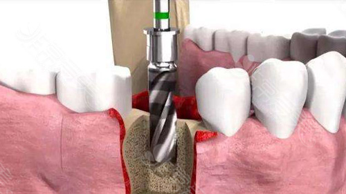 种植牙治疗过程图