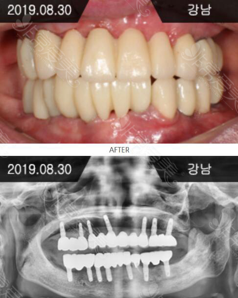 韩国来一菲全口种植牙术后照片