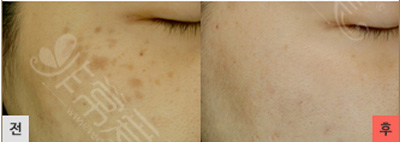 韩国LAMICHE皮肤科祛斑治疗前后对比图