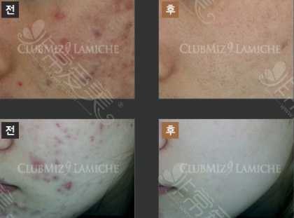 韩国LAMICHE皮肤科面部祛痘治疗对比图