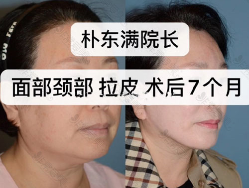 韩国BIO医院面颈部拉皮手术案例对比照