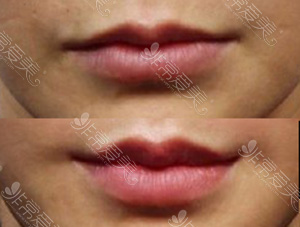 韩国HB整形外科唇部整形