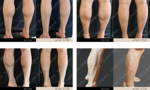 YAAN CLINIC皮肤整形医院小腿塑形术案例