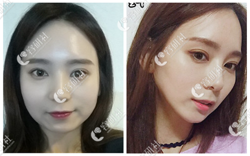 韩国YAAN CLINIC整形医院溶脂瘦脸案例