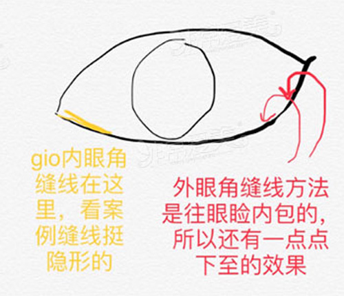 韩国Gio医院眼角修复缝线展示
