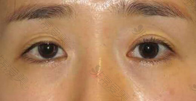 分享几组曹仁昌专门修复的“眼皮案例”！喜欢可以收藏下