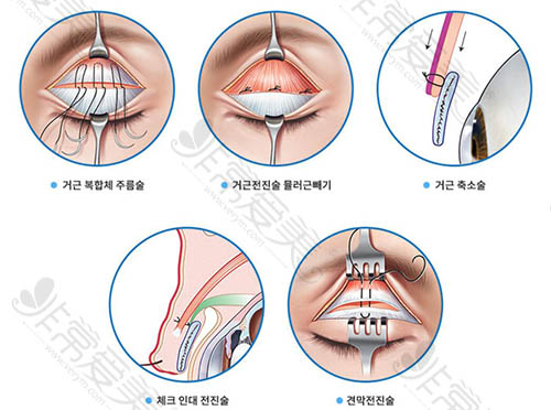 眼提肌修复手术方法
