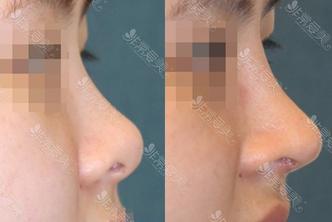 韩国kowon整形外科隆鼻案例效果
