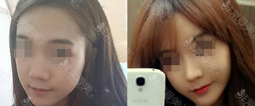 韩国kowon整形外科隆鼻案例图