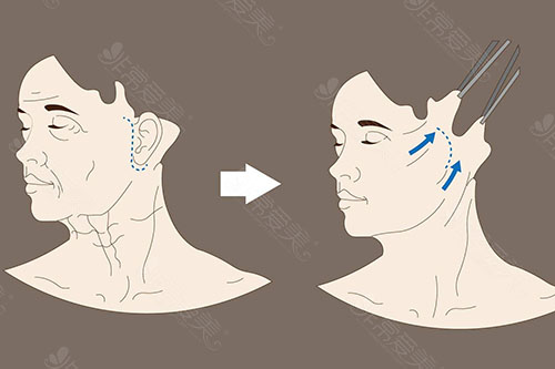 筋膜提升PK拉皮线雕区别，业内分析哪个手术效果维持时间久