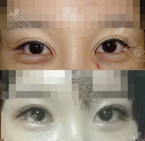 韩国双眼皮修复案例图