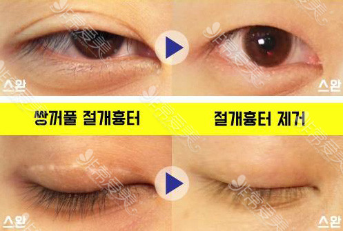 韩国双眼皮修复案例疤痕改善明显