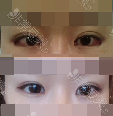 韩国双眼皮手术案例恢复效果图