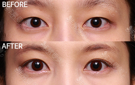韩国双眼皮手术案例图