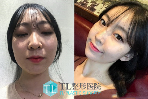 韩国TL整形外科自体脂肪填充全脸案例