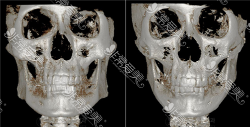 韩国脸本脸骨整形外科轮廓CT图