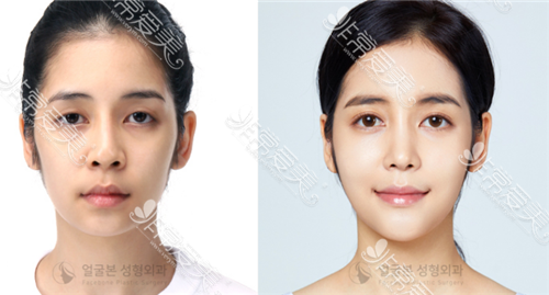 韩国脸本脸骨整形外科轮廓对比
