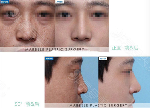 韩国玛博尔整形医院鼻部对比案例