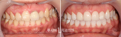 韩国柔欣爱牙科医院树脂牙贴片图