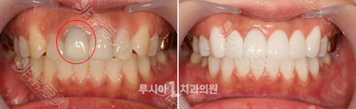 韩国柔欣爱牙科医院二氧化锆全瓷牙图