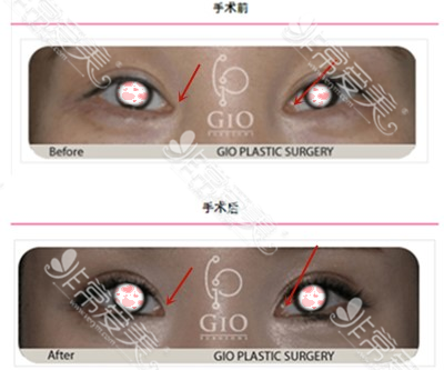 韩国GIO整形外科开眼角对比图